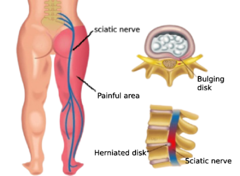 <a href="/treatment/sciatica/">સાયટીકા (SCIATICA)</a>