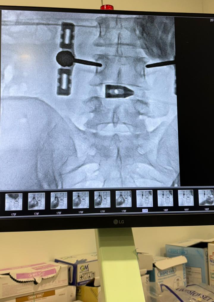BPSC American Method OLLIF Surgery